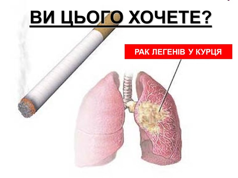 РАК ЛЕГЕНІВ У КУРЦЯ ВИ ЦЬОГО ХОЧЕТЕ?